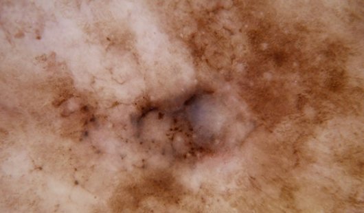 Melanoma on severely sun-damaged skin